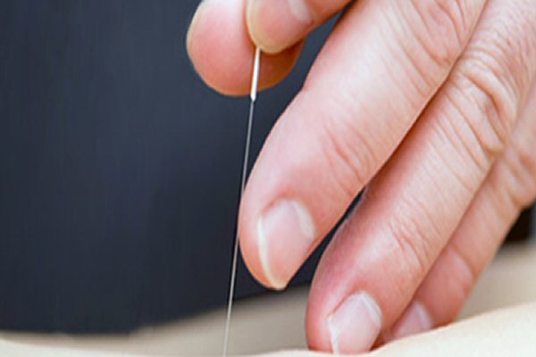 needling